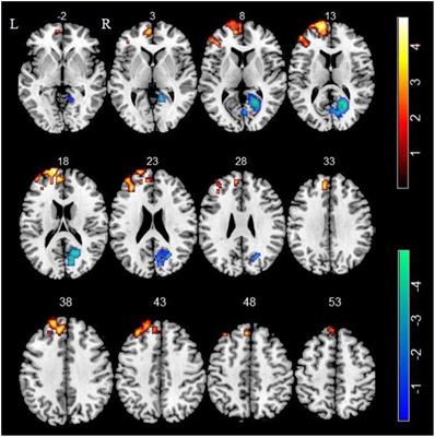 Increased spontaneous activity of the superior frontal gyrus with reduced functional connectivity to visual attention areas and cerebellum in male smokers